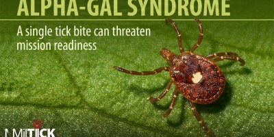 Alpha-Gal Syndrome is an unusual, sugar-triggered allergy initiated by the bite of the Lone Star tick and poses a unique threat to military readiness.