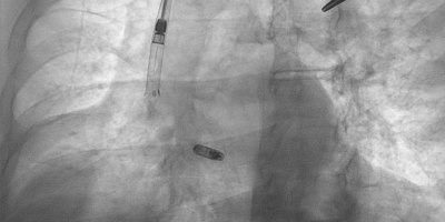 A radiographic image shows the "delivery sheath"--a tube cardiologists insert into a vein to provide access to the heart--and the pacemaker device (center) that will be secured in place to treat an irregular heartbeat.