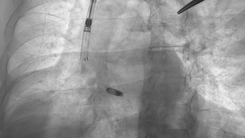 A radiographic image shows the "delivery sheath"--a tube cardiologists insert into a vein to provide access to the heart--and the pacemaker device (center) that will be secured in place to treat an irregular heartbeat.